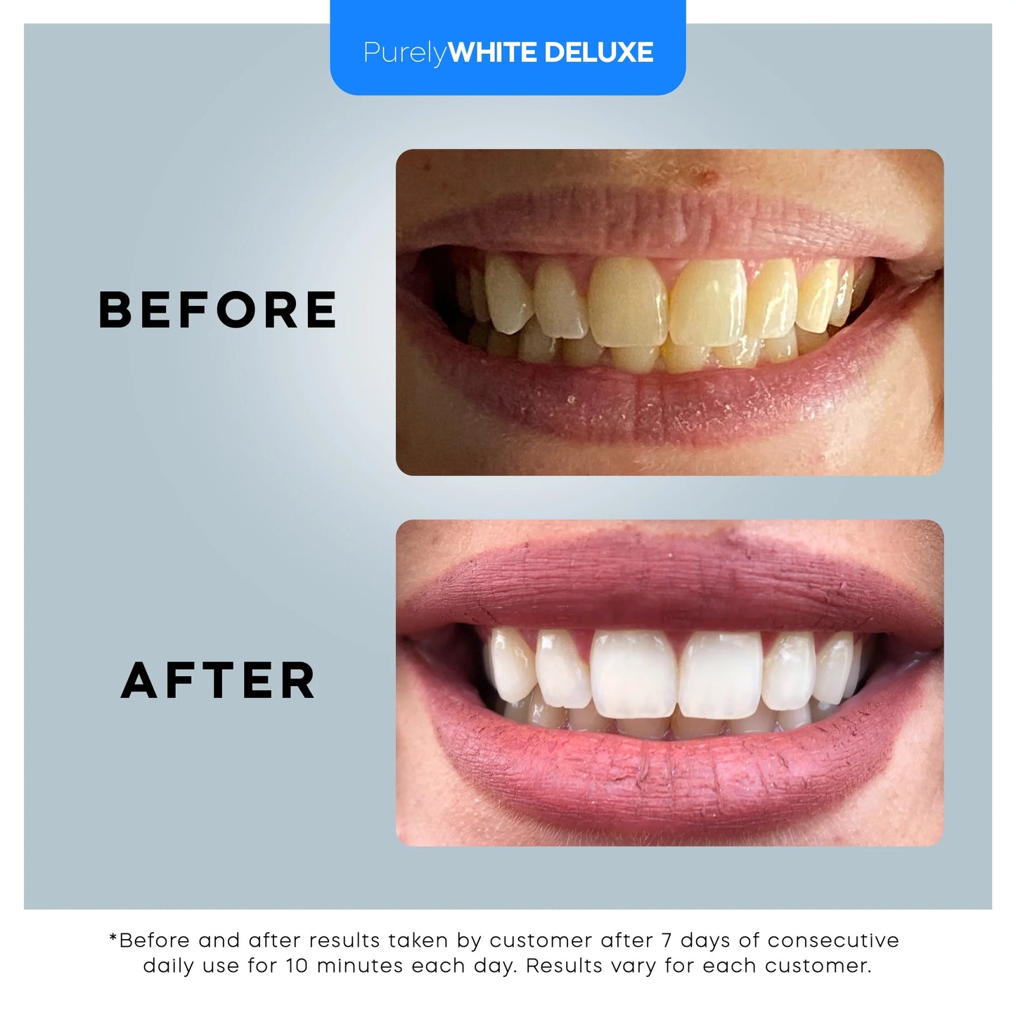 ULTRA Teeth Whitening Kit