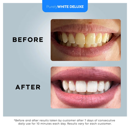 ULTRA Teeth Whitening Kit